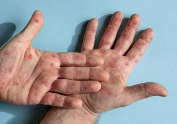 Sesapi confirma 10 casos da varíola dos macacos no Piauí; 55 são suspeitos - Foto: Reprodução